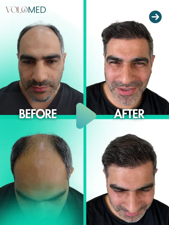 زراعة الشعر: قبل / بعد