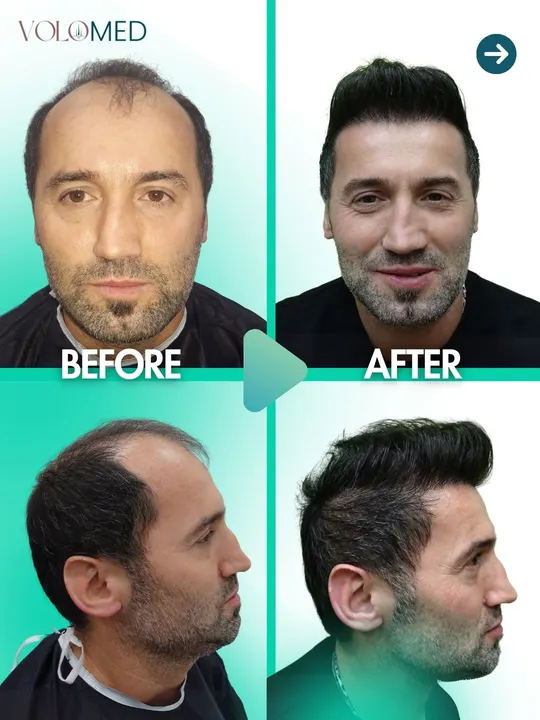زراعة الشعر: قبل / بعد