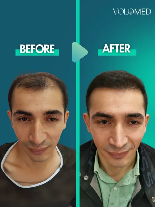 زراعة الشعر: قبل / بعد