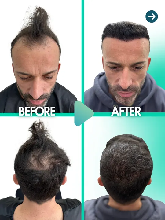 زراعة الشعر: قبل / بعد