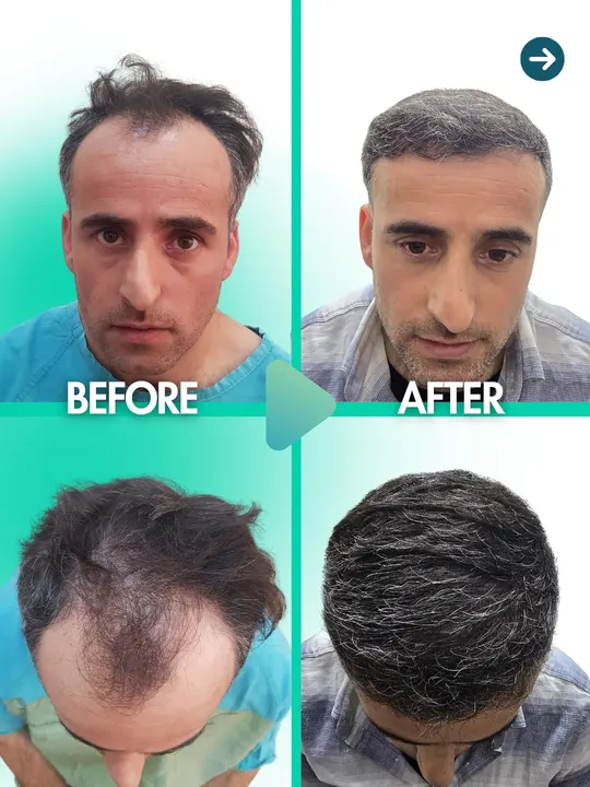 زراعة الشعر: قبل / بعد