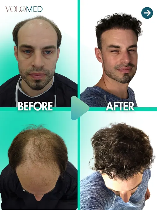 زراعة الشعر: قبل / بعد