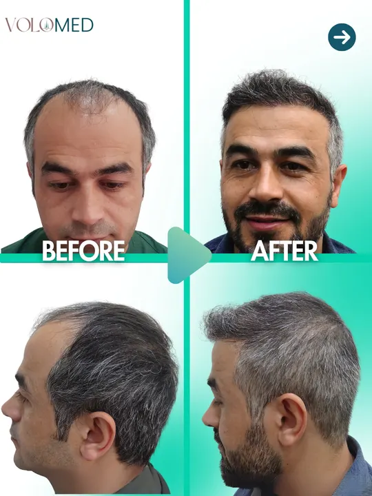زراعة الشعر: قبل / بعد