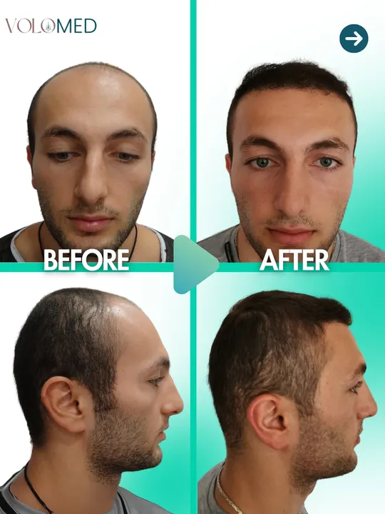 زراعة الشعر: قبل / بعد