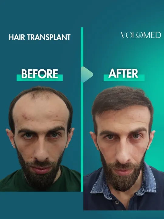 زراعة الشعر: قبل / بعد
