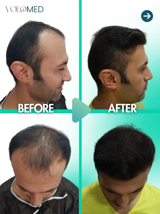 زراعة الشعر: قبل / بعد