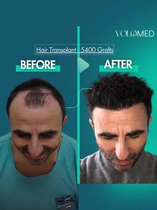 زراعة الشعر: قبل / بعد – 5,400 بصيلة
