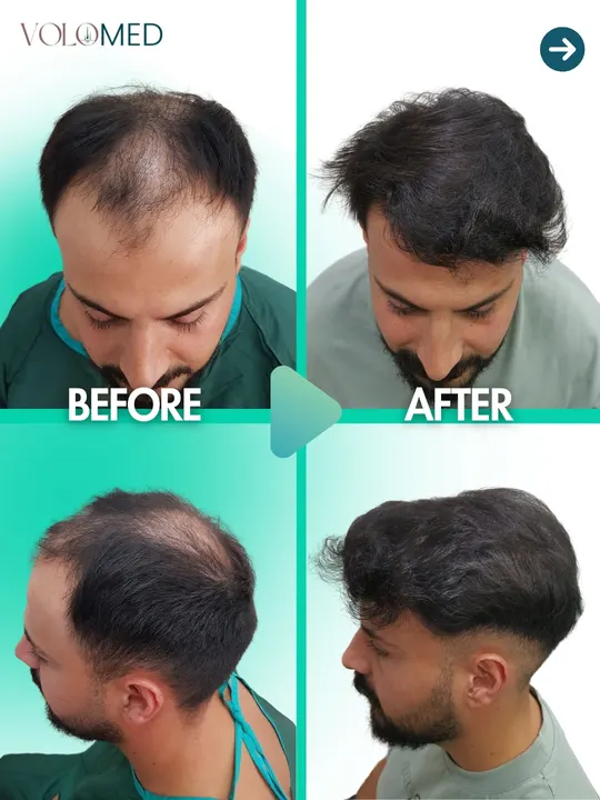 زراعة الشعر: قبل / بعد