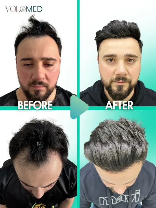 زراعة الشعر: قبل / بعد