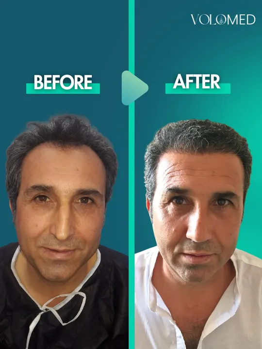 زراعة الشعر: قبل / بعد