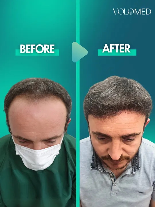 زراعة الشعر: قبل / بعد